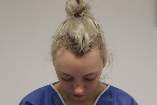 A patient with a receding hairline, highlighting hair loss concerns