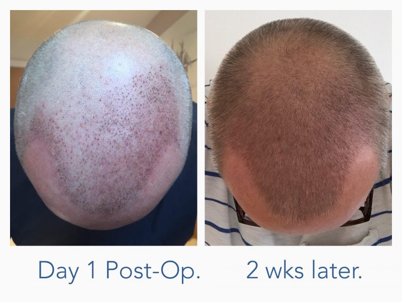 What is the result one month two months and three months after an FUE  hair transplant  Quora