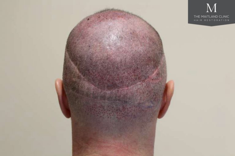 My 7th Hair Transplant Surgery - FUE Scalp, Beard Hair, FUE Into Scar