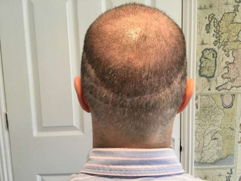 My 7th Hair Transplant Surgery - FUE Scalp, Beard Hair, FUE Into Scar ...