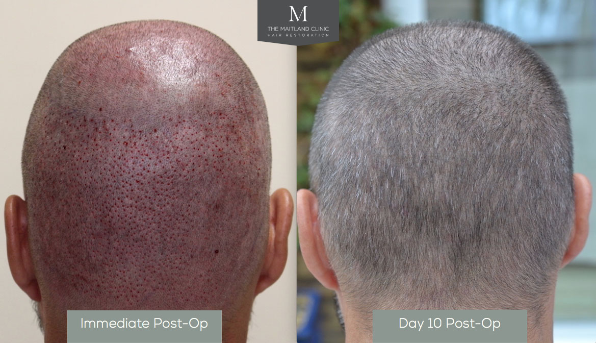 How To Prevent Hair Transplant Swelling  Wimpole Clinic