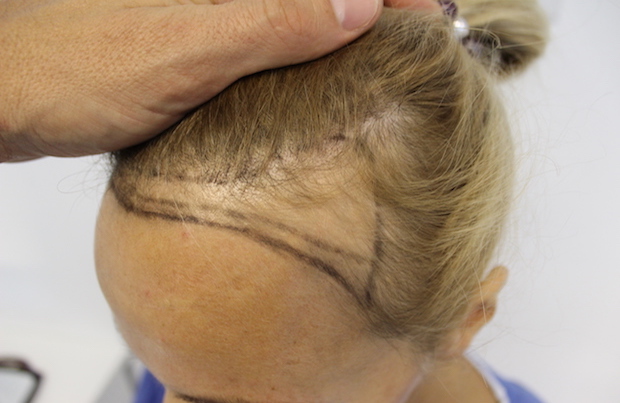 Alopecia treatment cost: all you need to know