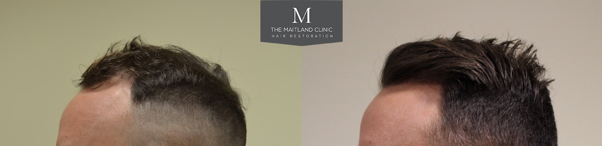 Dr Edward Ball - The Maitland Clinic - 1502 Grafts By FUE | Hair Loss ...