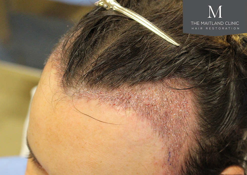 ID969_Before_righBefore and after female hair transplant UK Maitland Clinic hairline lowering