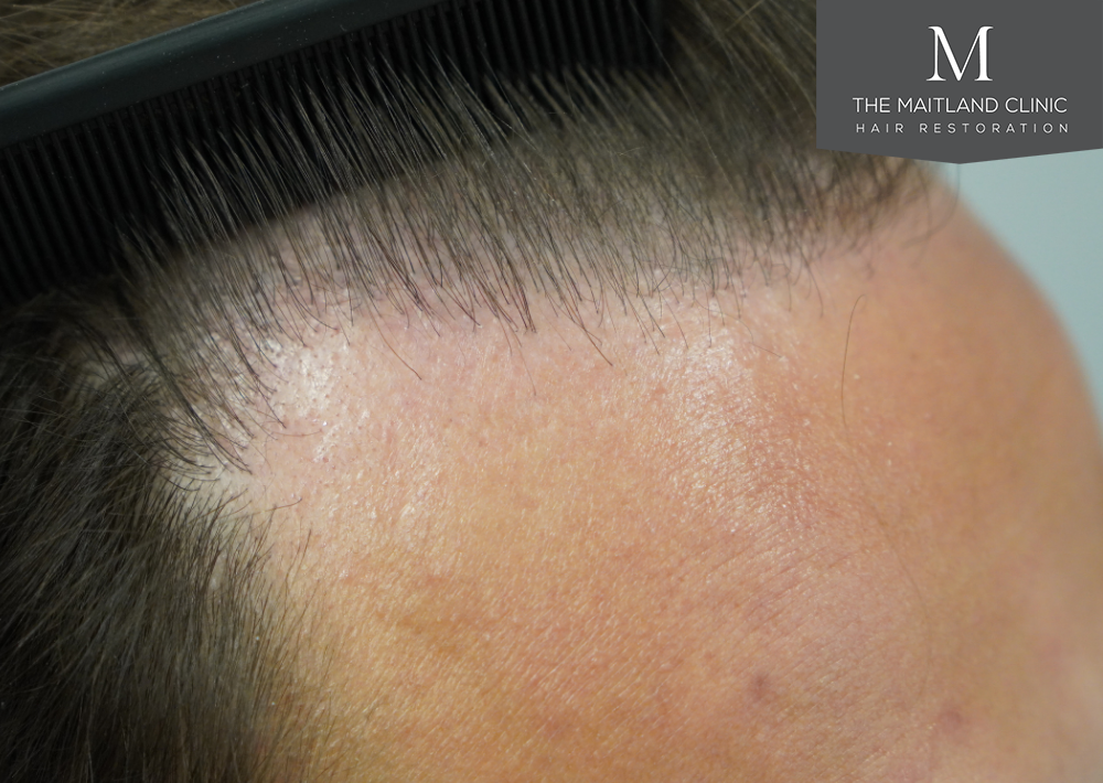 Repair surgery: FUE punch out removal of 464 hairline grafts