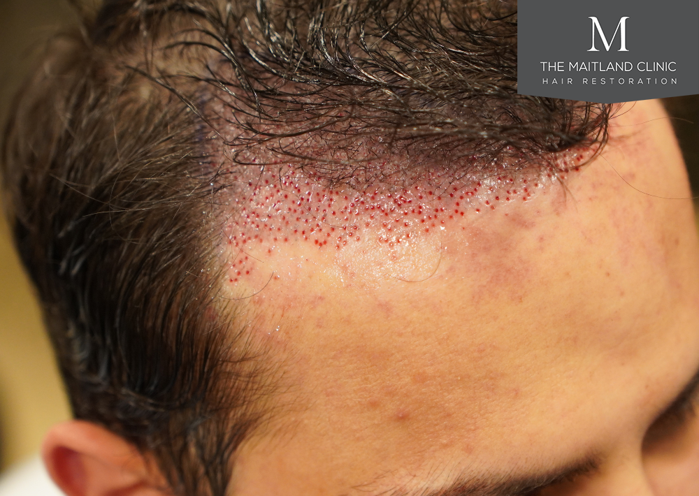 Repair surgery: FUE punch out removal of 464 hairline grafts